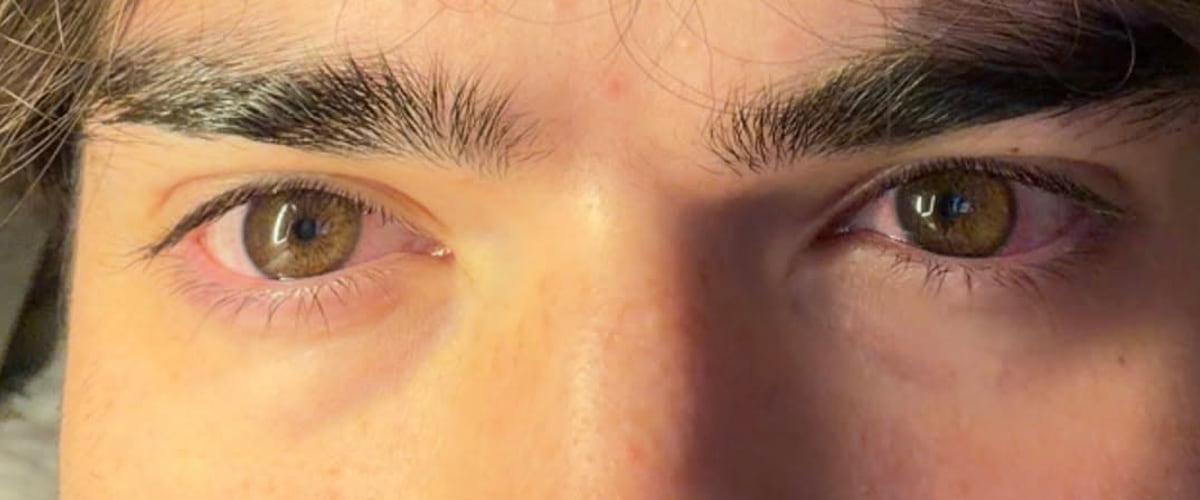 Both eyes after treatment, now light amber